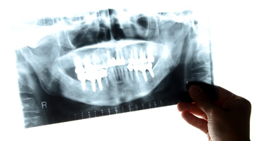 即日で仮歯を装着できるオールオン４治療の流れ