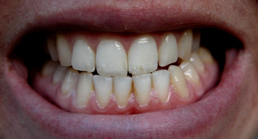 歯の老化を招く？歯の寿命に影響する歯ぎしり・食いしばりの危険性