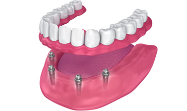 オールオン4の人工歯には歯茎がついている？！ブリッジと入れ歯との違いは？