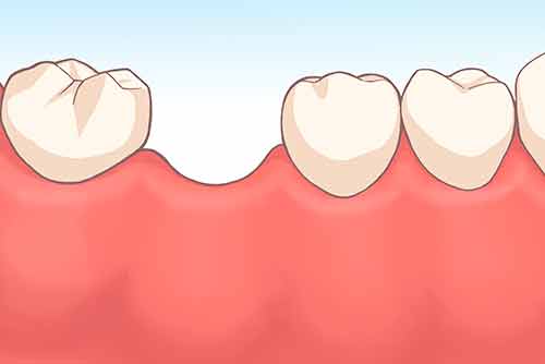 抜歯即時埋入インプラントの治療の流れ