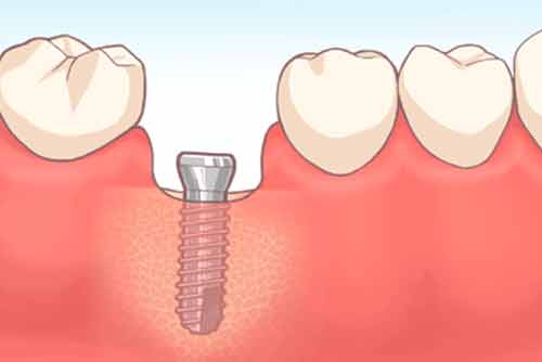 抜歯即時埋入インプラントの治療の流れ